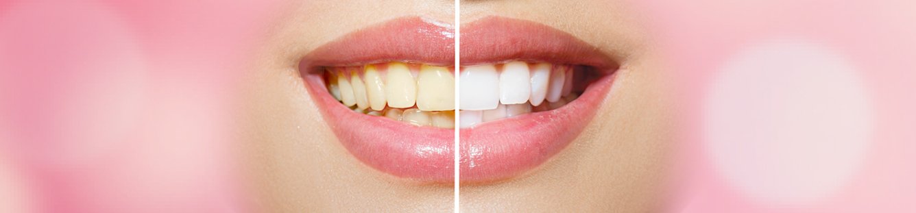 Before & After Teeth Whitening Treatment