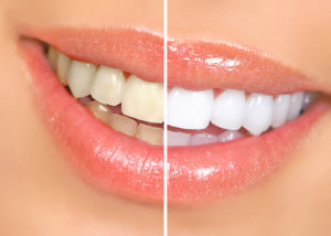How Our Fast Teeth Whitening Process Works