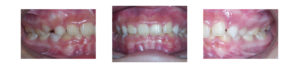 female patients' teeth before underbite correction