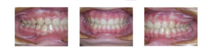 female patients' teeth after underbite correction