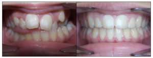 male patients' teeth before and after open bite correction