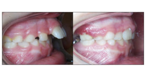 teeth before & after class II Herbst correction