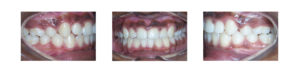 teeth after crowding correction