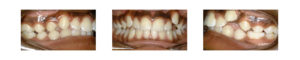  teeth before crowding correction