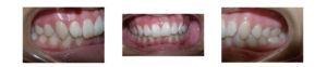 teeth before overbite correction