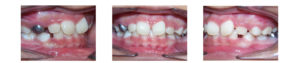 teeth before underbite correction