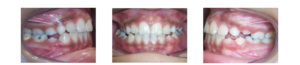 teeth before crossbite correction